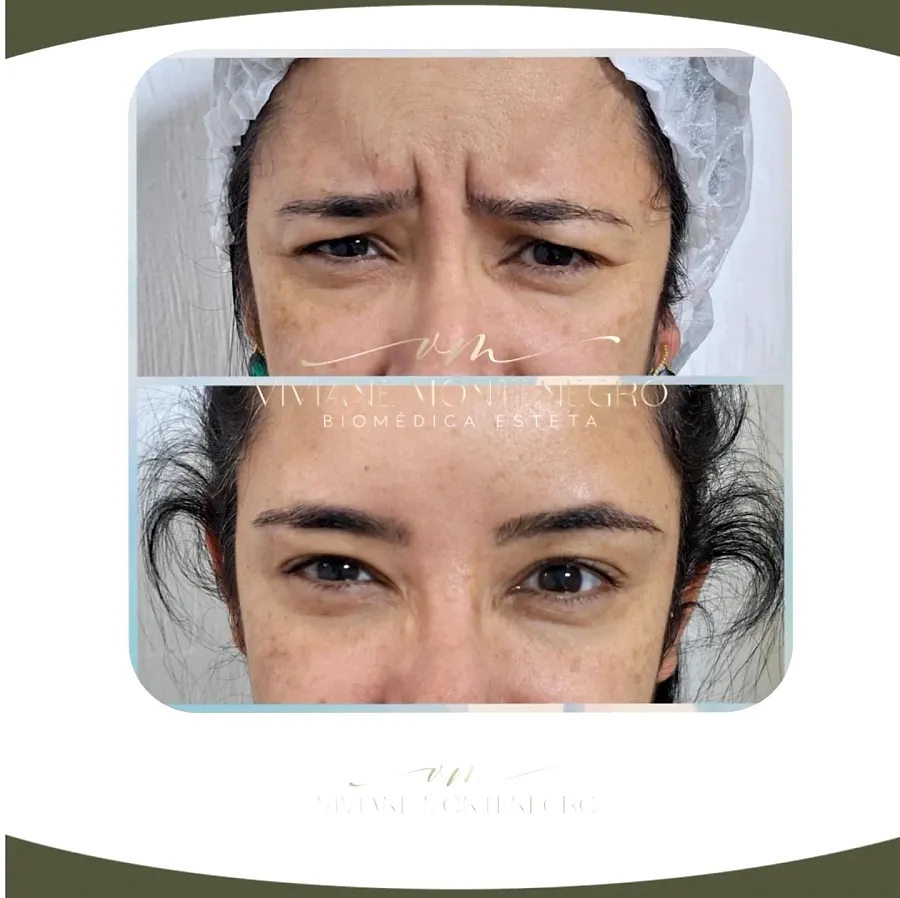 Antes e depois de tratamento das linhas de expressão da testa