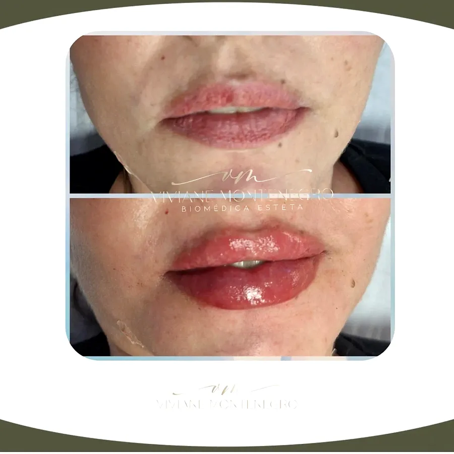Antes e depois de preenchimento labial