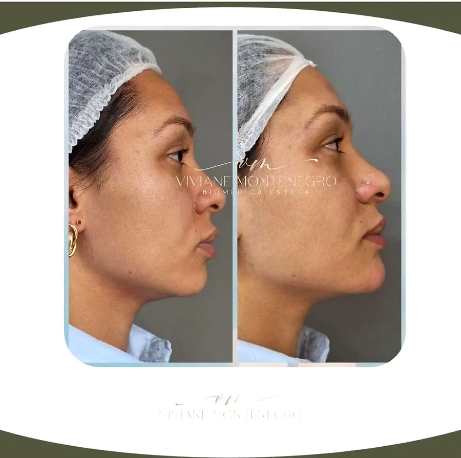 Antes e depois de harmonização facial, vista de perfil