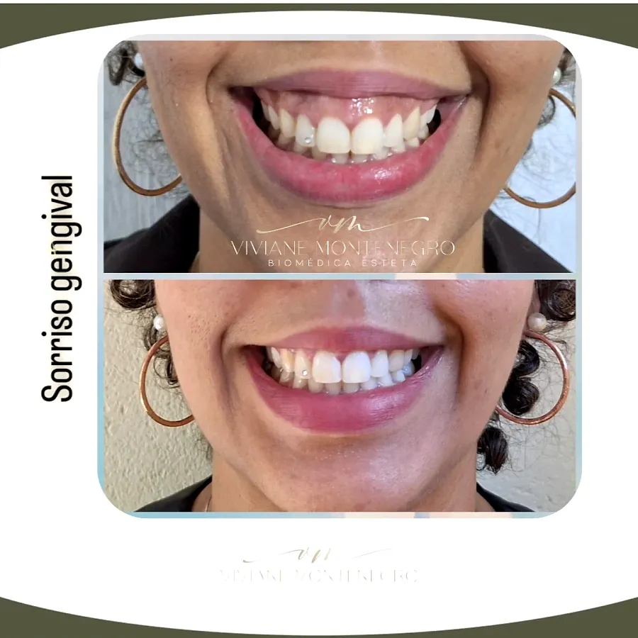 Antes e depois de tratamento do sorriso gengival
