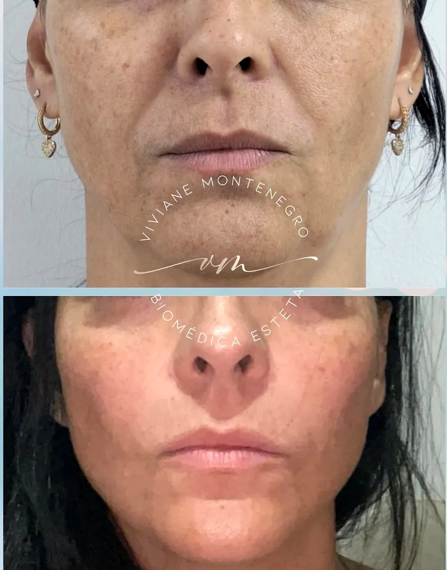 Antes e depois de preenchimento facial