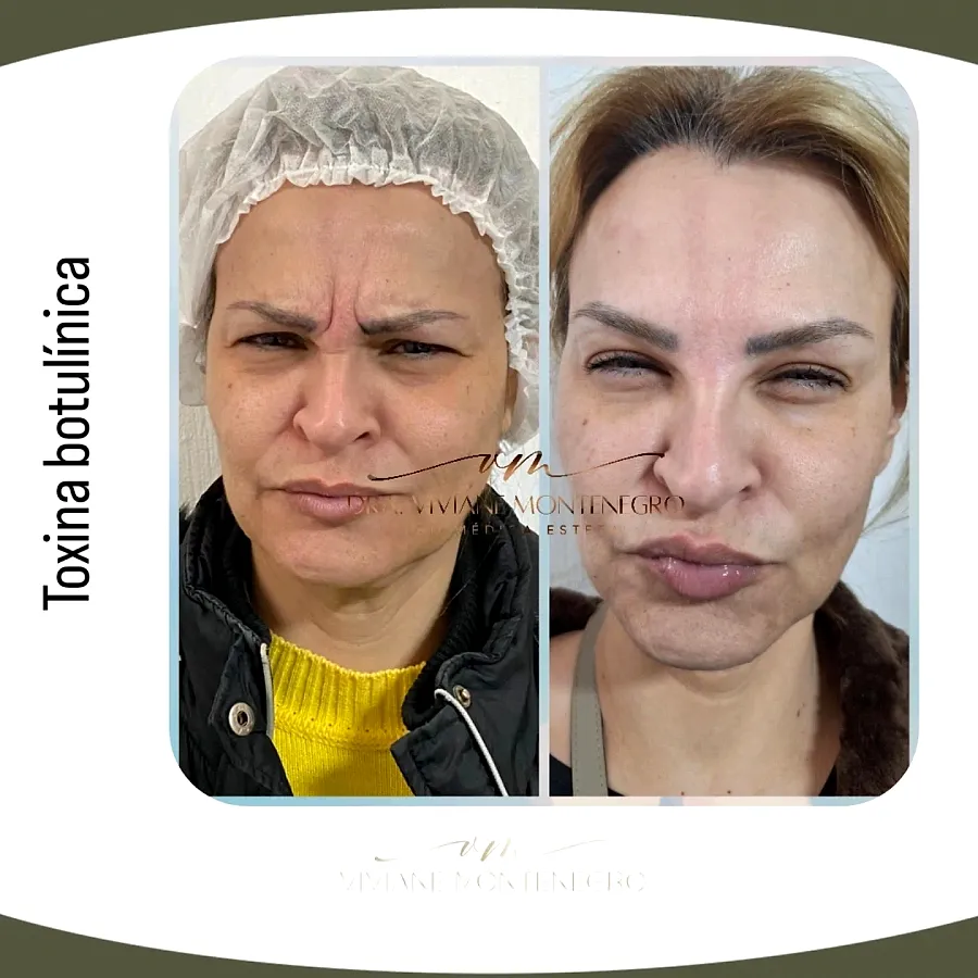 Antes e depois de aplicação de toxina botulínica