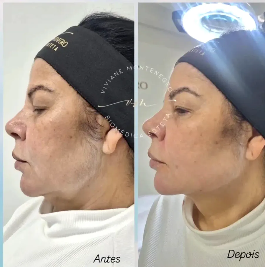 Antes e depois de Full Face, vista de perfil