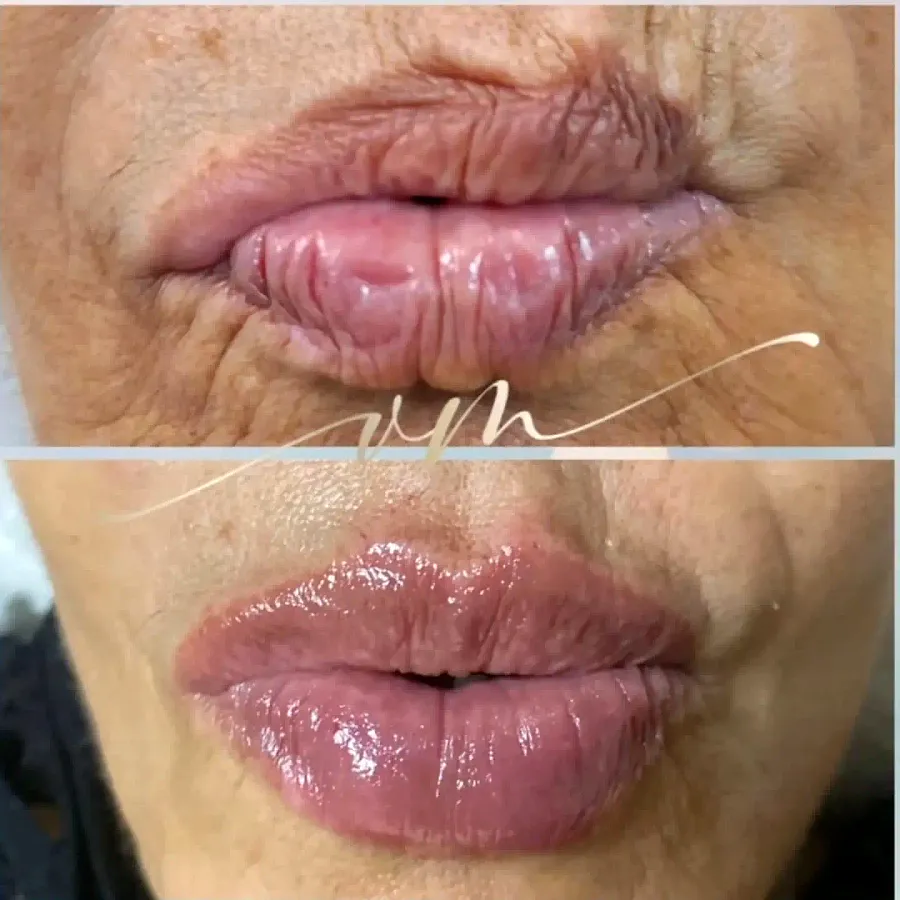 Antes e depois de preenchimento labial