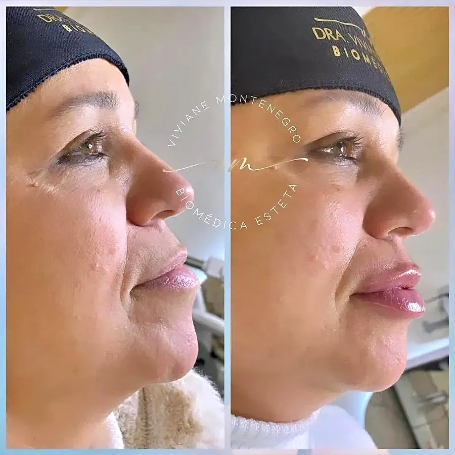 Antes e depois de preenchimento labial, vista de perfil