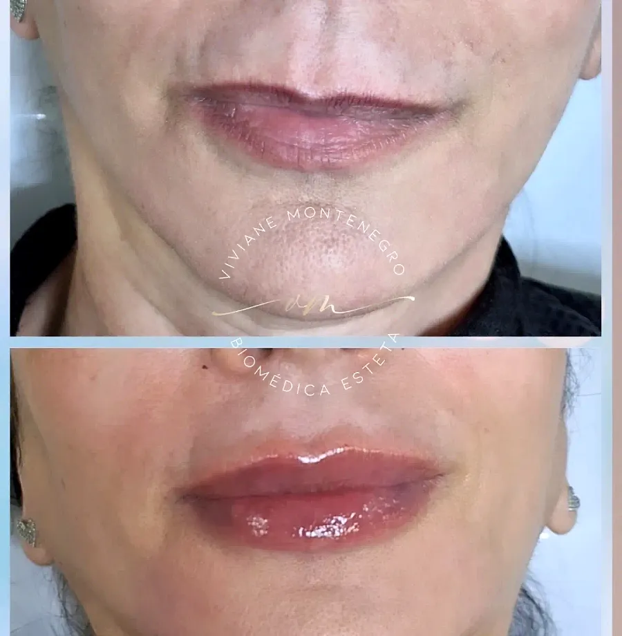Antes e depois de preenchimento labial